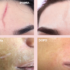 Cicatrici al viso: terapia pro bono per 500 donne
