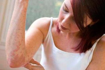 NOVITA’ PSORIASI:  UN FARMACO E UN PROGETTO WEB