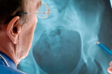 OSTEOPOROSI: SONO GLI UOMINI IL SESSO DEBOLE