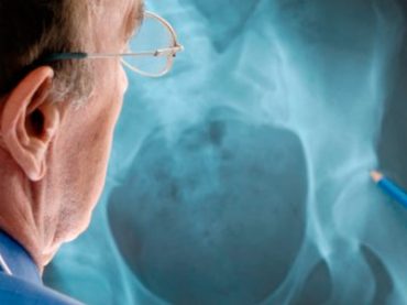 OSTEOPOROSI: SONO GLI UOMINI IL SESSO DEBOLE