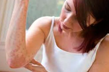 I GIOVANI E LO “STIGMA” DELLA PSORIASI