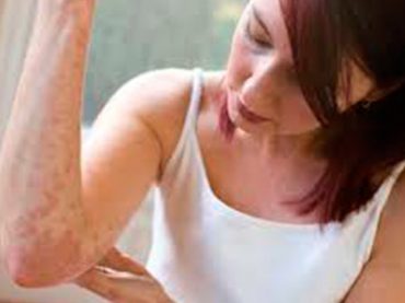 I GIOVANI E LO “STIGMA” DELLA PSORIASI