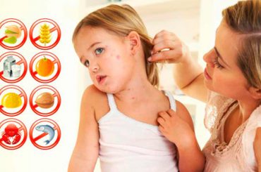 IN AUMENTO LE ALLERGIE ALIMENTARI: A RISCHIO IL 61% DEI BAMBINI IN ETA’ SCOLARE