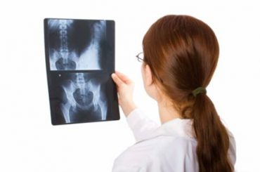 MESE DELLA PREVENZIONE: 10 DOMANDE SULL’OSTEOPOROSI