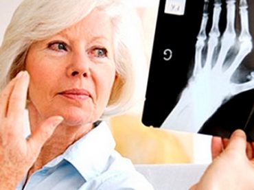 ARTRITE REUMATOIDE: PIU’ DOLOROSA DEL PARTO