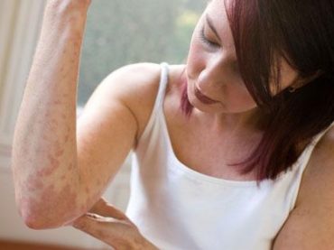 PSORIASI: SI CURA NEI CENTRI “DEDICATI”