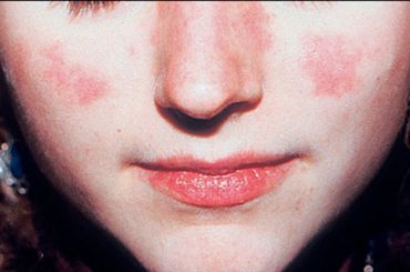 PSORIASI: I BENEFICI DELL’ESTATE