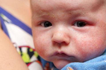 DERMATITE ATOPICA: COLPITI 2 BAMBINI SU 10, MA PREVENIRE E’ POSSIBILE