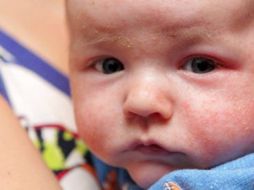 DERMATITE ATOPICA: COLPITI 2 BAMBINI SU 10, MA PREVENIRE E’ POSSIBILE