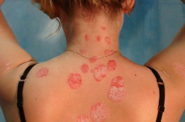 PSORIASI: «BASTA DISCRIMINAZIONI: ANCHE NOI ABBIAMO DIRITTO AI FARMACI»