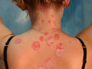 PSORIASI: «BASTA DISCRIMINAZIONI: ANCHE NOI ABBIAMO DIRITTO AI FARMACI»