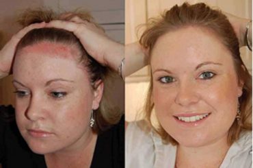 PSO BEAUTIFUL: ARRIVA IL RIMEDIO ESTETICO DELLA PSORIASI