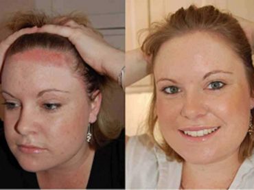 PSO BEAUTIFUL: ARRIVA IL RIMEDIO ESTETICO DELLA PSORIASI