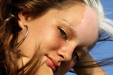 VITILIGINE: LA SPERANZA E’ NEL TRAPIANTO DI CELLULE