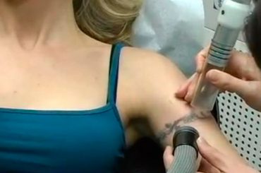 TATTOO: ORA E’ DI MODA CANCELLARLI. LO RACCOMANDANO ANCHE I DERMATOLOGI