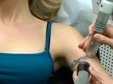 TATTOO: ORA E’ DI MODA CANCELLARLI. LO RACCOMANDANO ANCHE I DERMATOLOGI