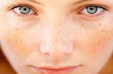 COME COMBATTERE LE MACCHIE BRUNE: 10 RISPOSTE