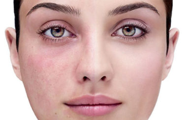 Acne, rosacea, dermatiti… le novità per la pelle