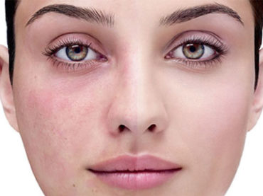 Acne, rosacea, dermatiti… le novità per la pelle