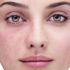 Acne, rosacea, dermatiti… le novità per la pelle