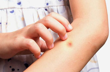 Come difendersi dal pericolo insetti