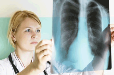 Immunoterapia: la nuova cura per i tumori polmonari avanzati