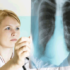 Immunoterapia: la nuova cura per i tumori polmonari avanzati