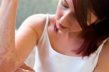 Buone notizie per la cura della psoriasi