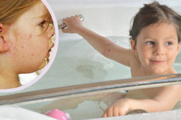 Curare la dermatite atopica previene le allergie