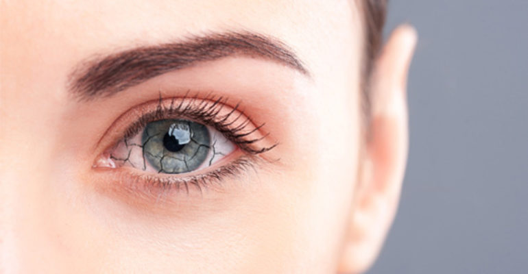 Occhio secco: tre volte più frequente nelle donne