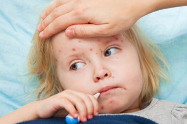 Obblighi vaccinali: il morbillo spiegato in 8 punti