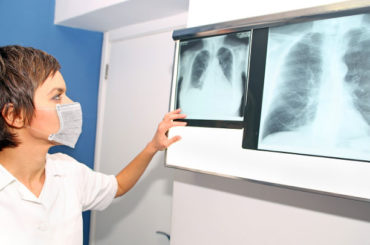 Tromboembolia da Covid-19: si previene con farmaci appropriati