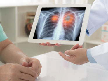 Tumore del polmone: l’immunoterapia può diventare una cura