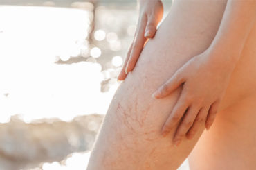 Gambe in estate: attenzione alla malattia venosa cronica