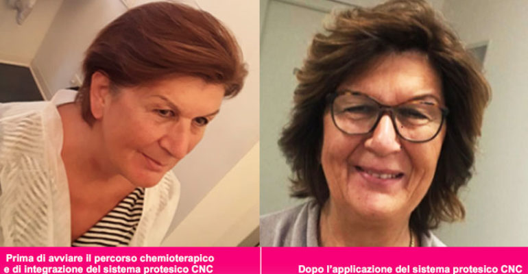 Alopecia da chemio: un innovativo sistema protesico migliora il benessere psicologico