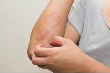 I campanelli d’allarme del Covid sulla pelle