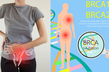 Tumore all’ovaio: continua la rivoluzione dei PARP inibitori