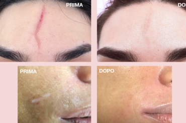 Cicatrici al viso: terapia pro bono per 500 donne