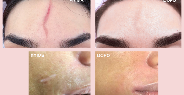 Cicatrici al viso: terapia pro bono per 500 donne