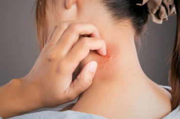 “Dermatite Atopica: Rimettiti in gioco” con le nuove terapie per sconfiggerla