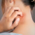 “Dermatite Atopica: Rimettiti in gioco” con le nuove terapie per sconfiggerla