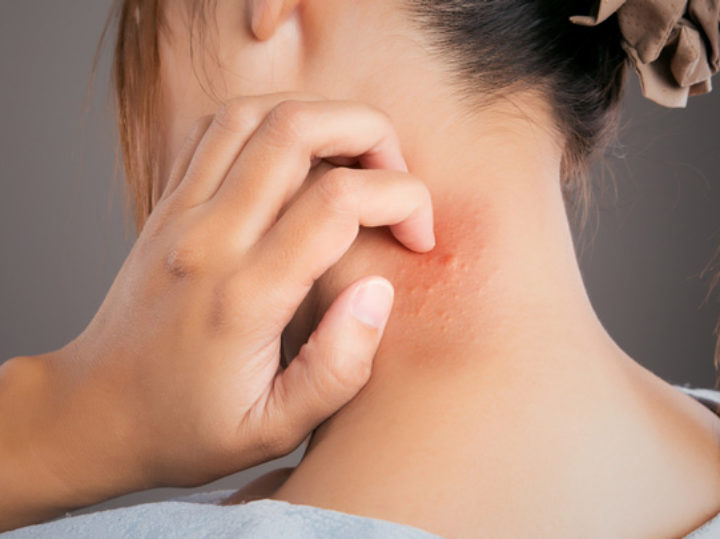 “Dermatite Atopica: Rimettiti in gioco” con le nuove terapie per sconfiggerla