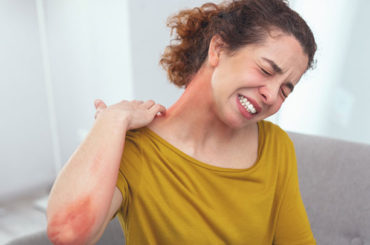 Dermatite atopica: innovativa terapia orale