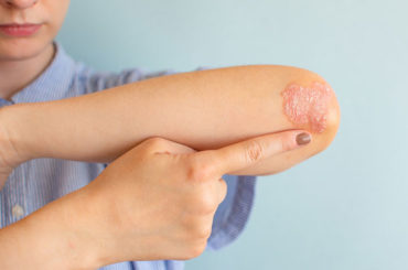 Psoriasi: nuovi farmaci e una campagna d’informazione