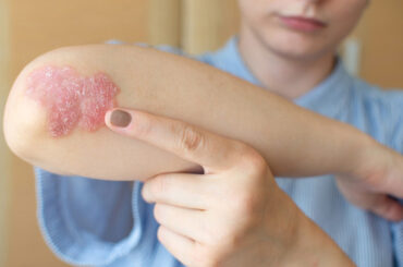 Stare insieme fa bene, anche alla pelle