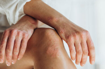 Artrite psoriasica: diagnosi e cure contro i danni irreversibili