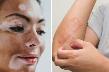 <em>Flash mob</em> sulla vitiligine e altre… “questioni di pelle”