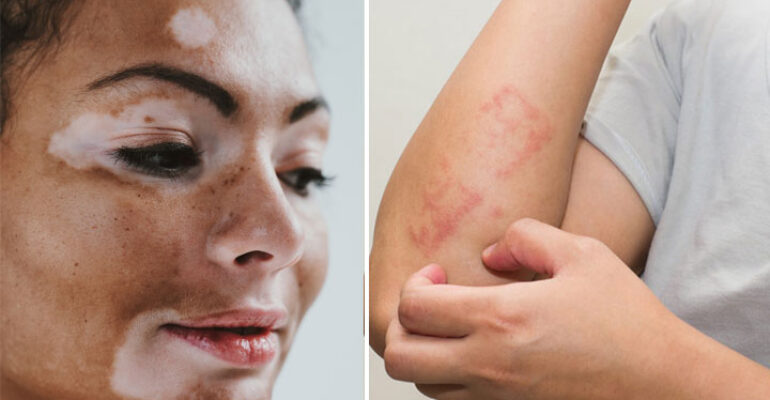 <em>Flash mob</em> sulla vitiligine e altre… “questioni di pelle”