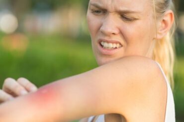 Febbre del Nilo: sintomi, rischi e prevenzione