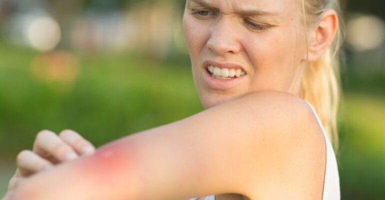 Febbre del Nilo: sintomi, rischi e prevenzione